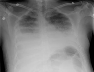 patient has large bilateral pleural effusions on chest x-ray