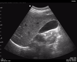 gallbladder ultrasound