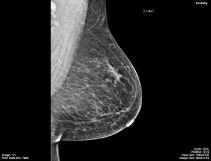 Mammography image