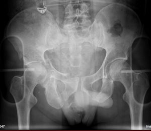 pre-op x-ray of pelvis