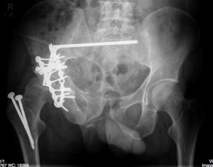 post-op x-ray of pelvis