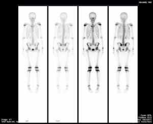 pediatric bone scan