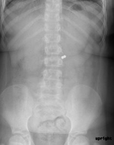 child has swallowed a foreign object