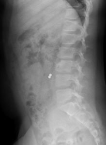 child has swallowed a foreign object