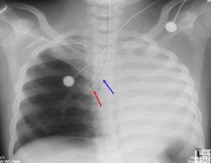 chest x-ray one lung is fully collapsed