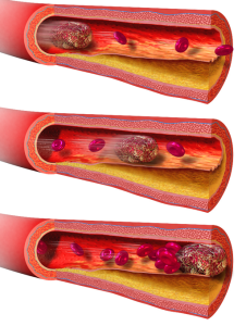 3 illustrations showing the development of a blood clot