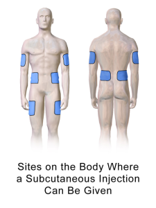 Blue patches on a body showing where subcutaneous injections can be given
