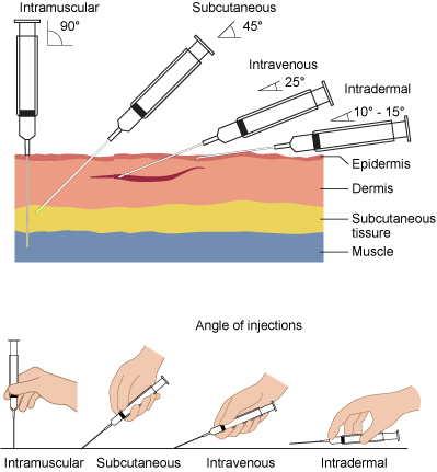 Needle insertion angles at 90 degrees for intramuscular, 45 degrees for subcutaneous, 25 degrees for intravenous, 10 to 15 degrees for intradermal
