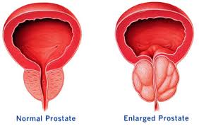 Normal prostate on the left compared with an enlarged prostate on the right