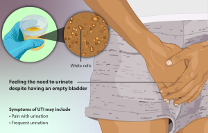 Illustration of a woman with a urinary tract infection, including a depiction of a urine sample with white blood cells. Text description Feeling the need to urinate despite having andempty bladder and symptoms of UTI may include pain with urination and frequent urination