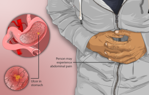 Depiction of a patient sufferring from a peptic ulcer including illustration of ulcer in the stomach