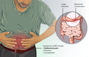 Illustrations of man suffereing from irritable bowel syndrome and the large intestine with abnormal contractions highlighted in red