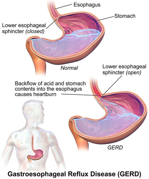Labelled illustration of gastroesophageal reflux disease (GERD) showing two crosssections of the stomach, one normal and one with GERD showing the backflow of acid contents in the esophagus