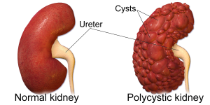 Fig. 2.6 is an image of a normal kidney and a kidney with PKD.