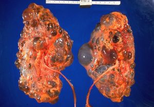 Fig. 2.7 is an image of two kidneys with PKD, and you can clearly see the cyst formation on each of the kidneys.