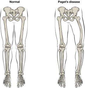 Two illustrations from the pelvis to the feet comparing a normal skeleton and a skeleton with Paget's disease