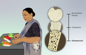 illustration of someone with osteoporosis with a diagram showing normal bone density, ostepenia and osteporosis