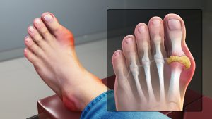 animation still showing gout in a large toe; inset image shows the build up of uric acid crystals in the joint