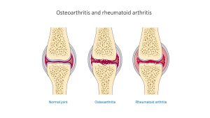 Three illustrations comparing a normal joint, and joints with osteoarthritis and rheumatoid arthritis