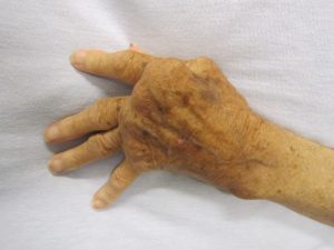 photograph of a hand with severe rheumatoid arthritis