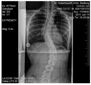 x-ray image of scoliosis in a 15 year old