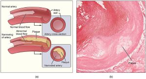 Atherosclerosis with illustrations of a normal artery with normal blood flow and an artery where there is narrowing of the artery due to plaque and abnormal blood flow