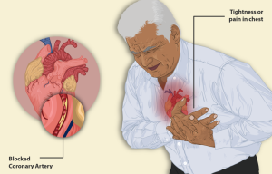 Wikiepdia: "An illustration of a man feeling tightness or pain in the chest - a symptom of angina or of a heart attack."