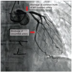 Photograph showing blockage of a common trunk of left coronary artery and blockage of circumflex artery