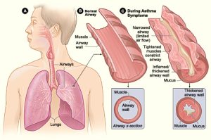 Illustration of asthma attack showing the lungs and a close up of a normal airway and a thickened airway full of mucus during an asthma attack