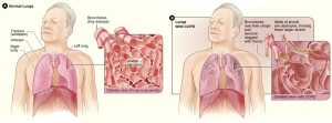 Illustration showing a man with normal lungs and a man with COPD -- compares normal bronchioles and abrnormal bronchioles clogged with mucus