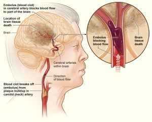 From Wikipedia: "The illustration shows how an ischemic stroke can occur in the brain. If a blood clot breaks away from plaque buildup in a carotid (neck) artery, it can travel to and lodge in an artery in the brain. The clot can block blood flow to part of the brain, causing brain tissue death."