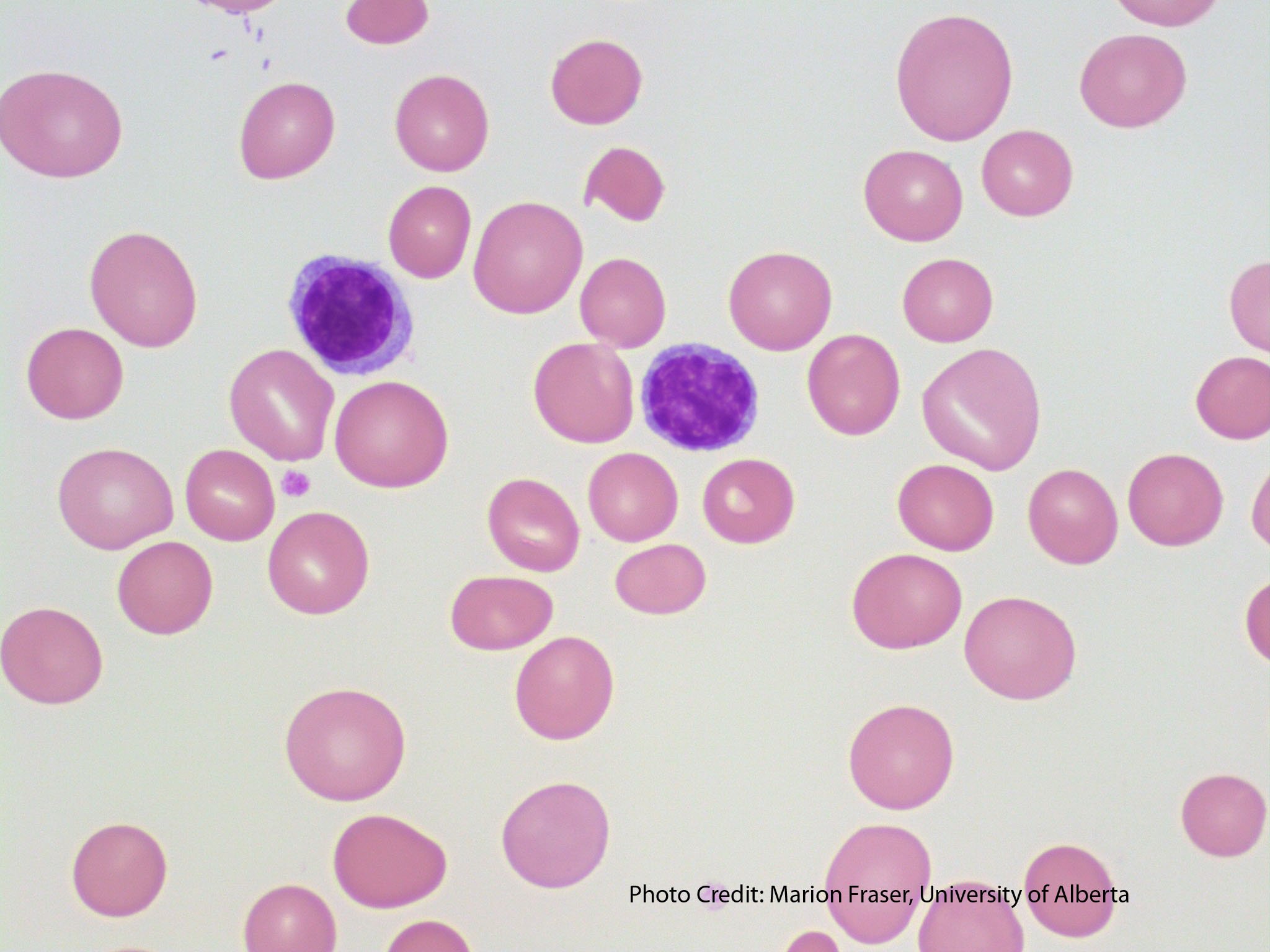 Megaloblastic Anemia – A Laboratory Guide to Clinical Hematology