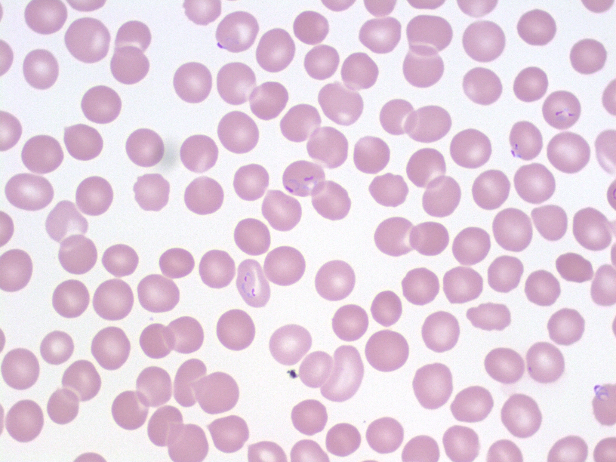 Red Blood Cell Infected with Malaria Parasite Plasmodium Vivax, Ring Stage  Stock Illustration - Illustration of infectious, illness: 159917951