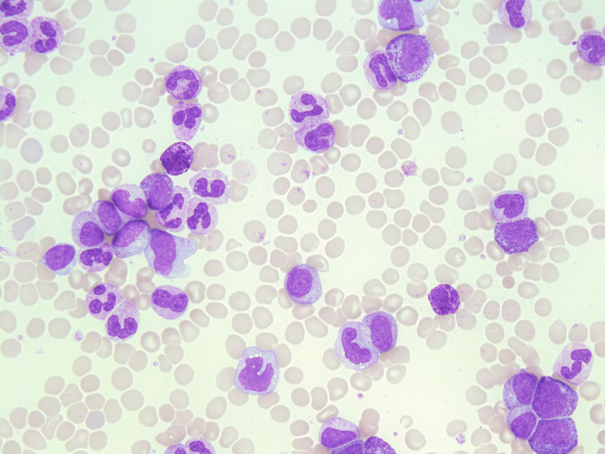 Normal mature neutrophilic granulocyte in peripheral blood smear