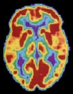 A PET brain scan shows different parts of the brain in different colors.