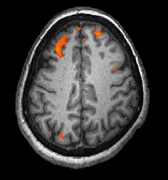 A fMRI brain scan shows brain tissue in gray with some small areas highlighted red.